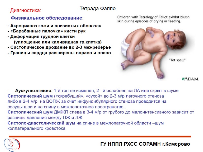 ГУ НППЛ РХСС СОРАМН г.Кемерово Тетрада Фалло. Физикальное обследование: Диагностика: - Акроцианоз кожи и